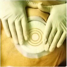 Coloplast (10 Adet) 33353 Comfeel Plus B - Coloplast ( Adet) Comfeel Plus Basınç ıcı Hidrokolloid Yara Örtüsü Cm