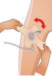 Medikaltec AngioPad Angio Pad